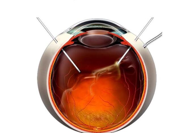 Vitrectomie – chirurgie pour restaurer la vision